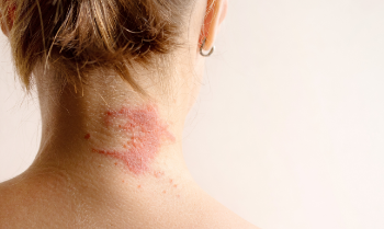 10 Best Medications for Atopic Dermatitis Skin Rash